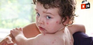 ¡Alerta de Varicela en Canutillo! Estudiante Vacunado da Positivo