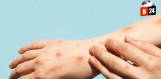 ¡Alerta Sanitaria! Casos de Viruela del Mono se Disparan en México