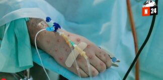 ¡Alerta Sanitaria: México Mantiene Bajo Control la Viruela del Mono!