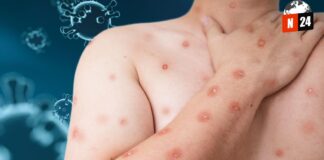 ¡Alerta Sanitaria: Expertos Capacitan a Profesionales de la Salud sobre el Mpox!